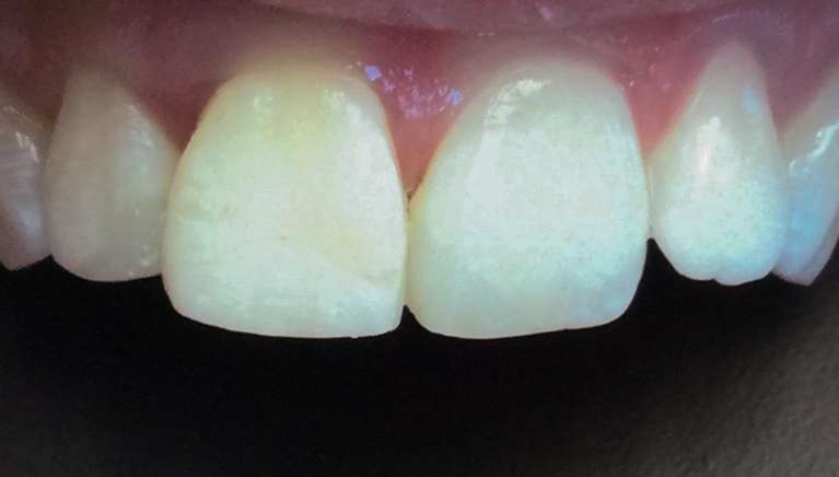 Composite-Bonding-After-Image