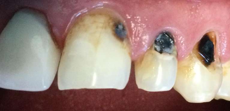 Tooth-Colored-Fillings-Before-Image